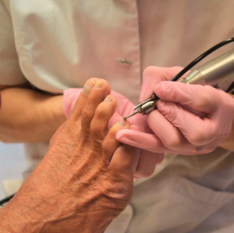 Een teennagel wordt behandeld met een nagelfrees in de praktijk